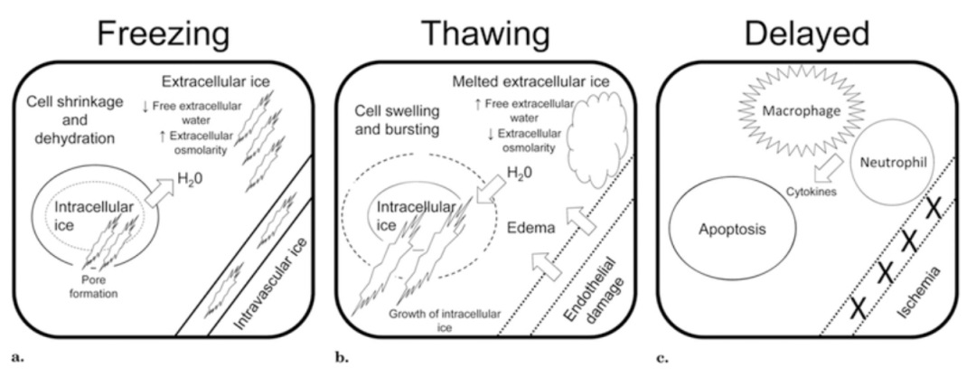 肿瘤医治界的「高冷之花」——肿瘤微创冷冻消融，国产代替设备空间巨大